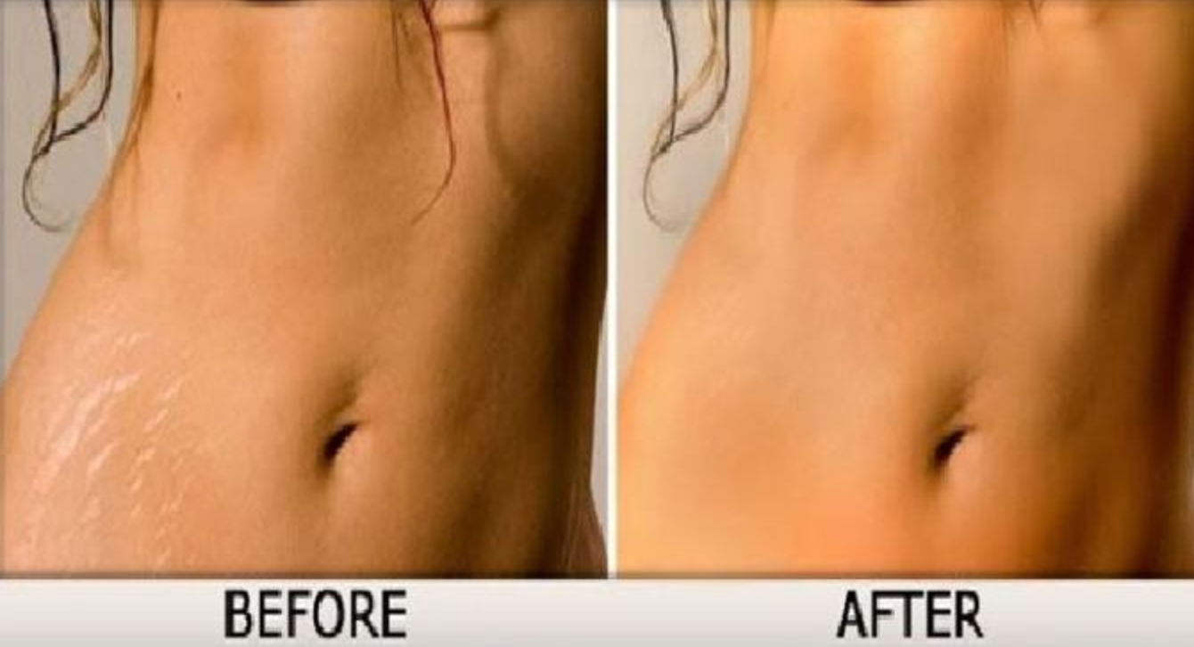 Removal of stretch marks