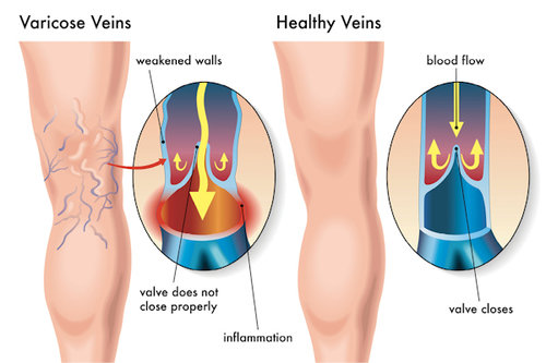 Foods That Help Reduce the Appearance of Spider Veins